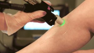 Pain Free Laser hair removal at The Spa Therapy Room